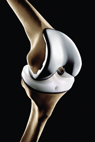 knee-implant